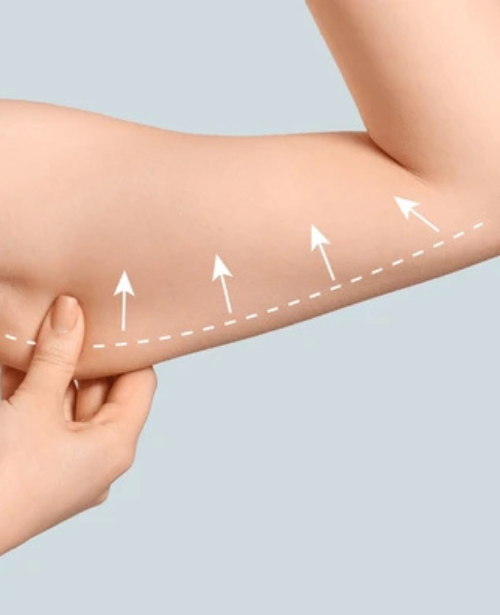 Arm Lift (Brachioplasty)