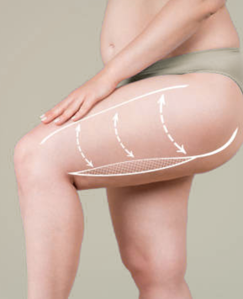 Outer Thigh or Extended Lift