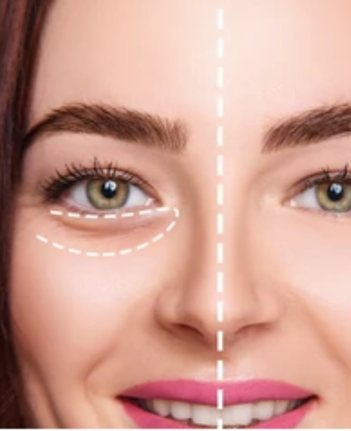 Undereye Fillers