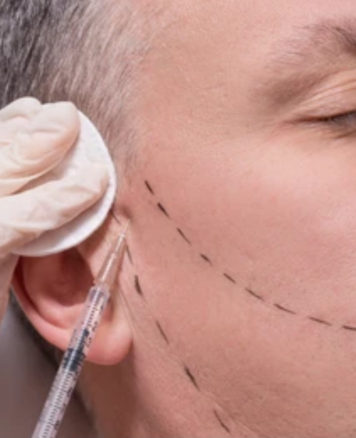 Sideburn and Jawline Transplant