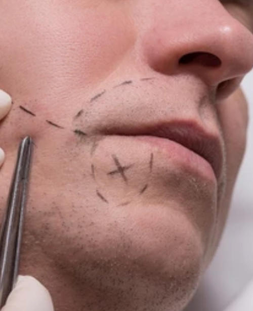 Goatee & Mustache Transplant