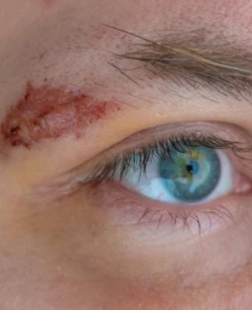 Reconstructive Eyebrow Transplant