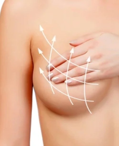 Mini Lift (Periareolar)