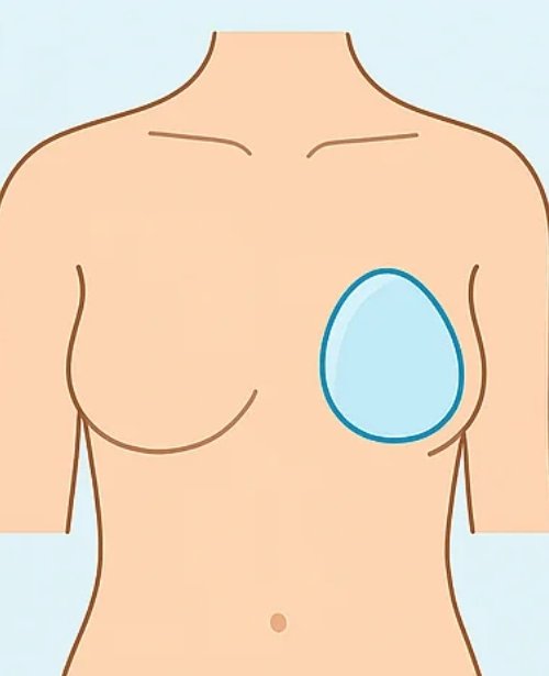 Autologous (Flap) Re-construction