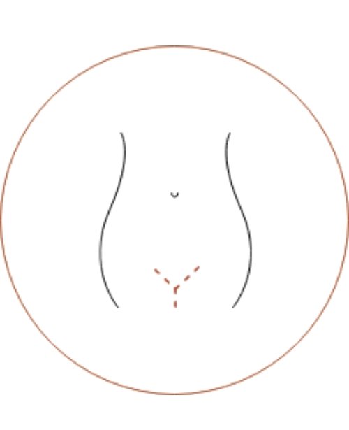 Composite Labiaplasty