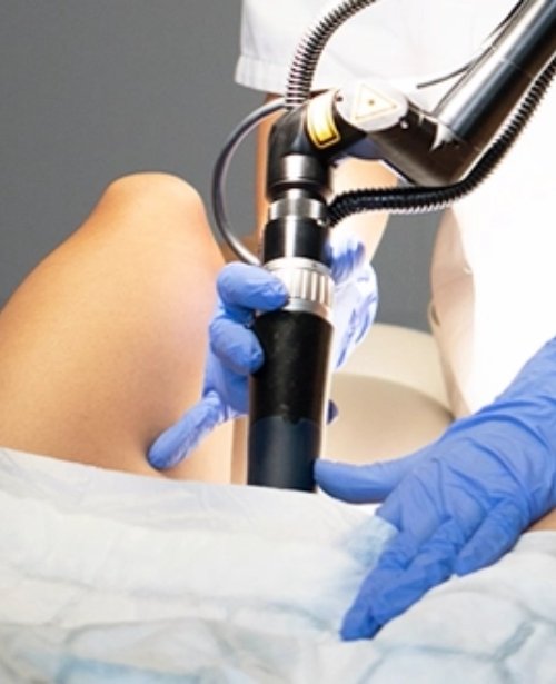 Radiofrequency (RF) Vaginal Rejuvenation