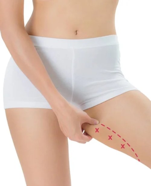 Inner Thigh Lift