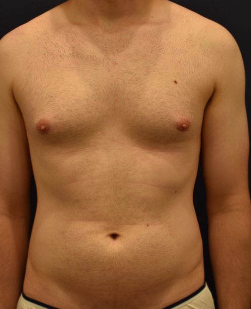 Grade I (Mild Enlargement)