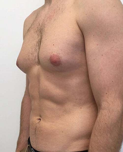 Grade III (Severe Enlargement)