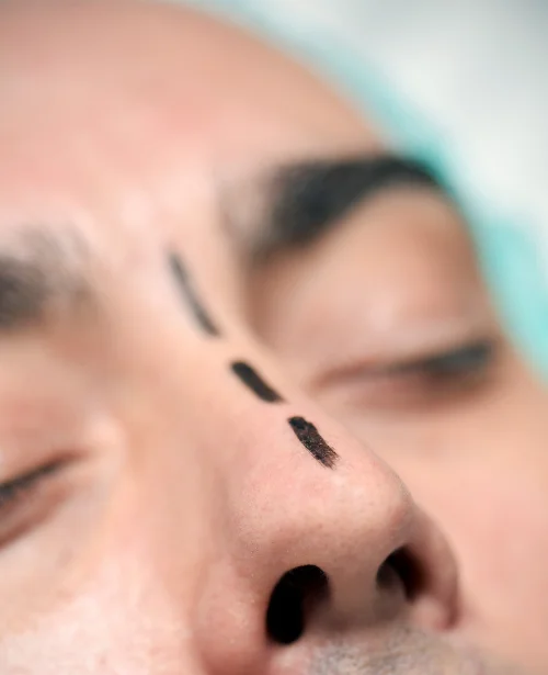 Functional Rhinoplasty