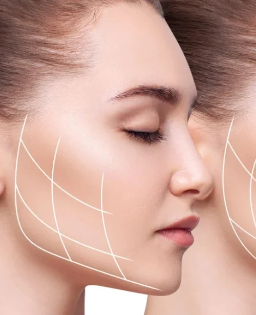 Traditional Buccal Fat Removal