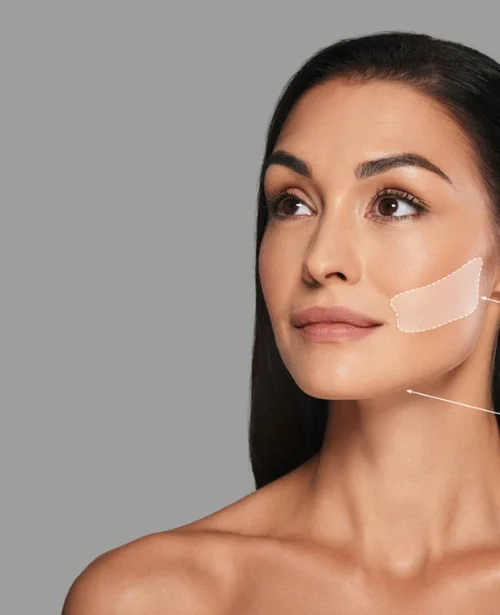 Partial Buccal Contouring