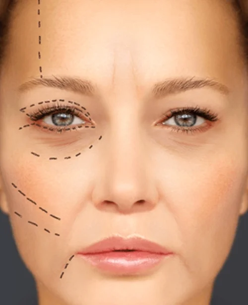 Under Eye Fat Transfer