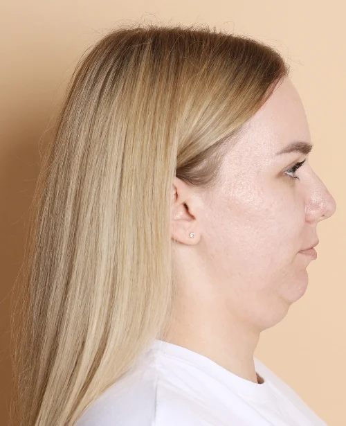 Double Chin Removal